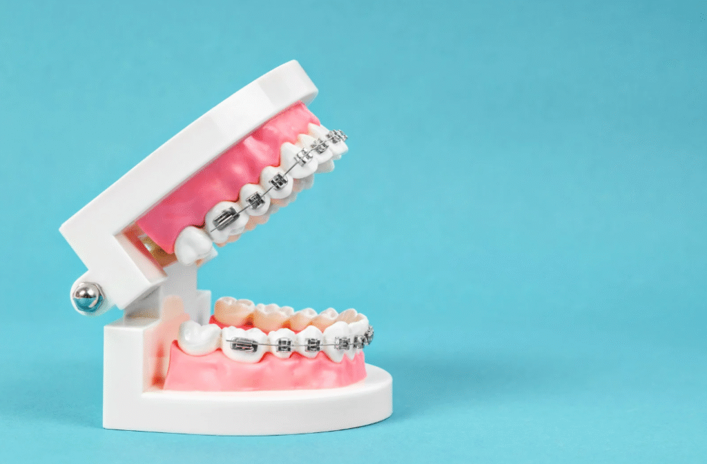 Types of Braces 牙箍種類