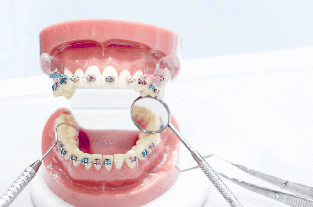 What Is Orthodontics 箍牙原理