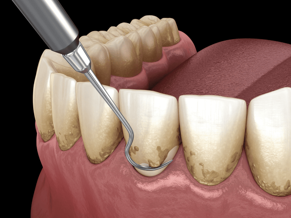 洗牙好處 Benefits of Teeth Cleaning