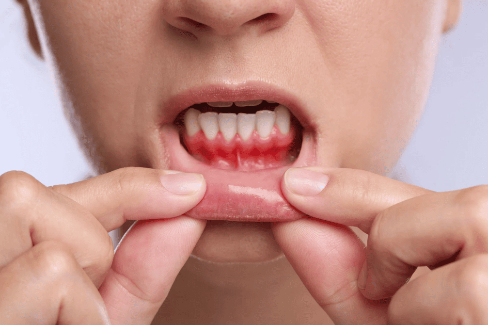 什麼是牙肉發炎 what is gum inflammation