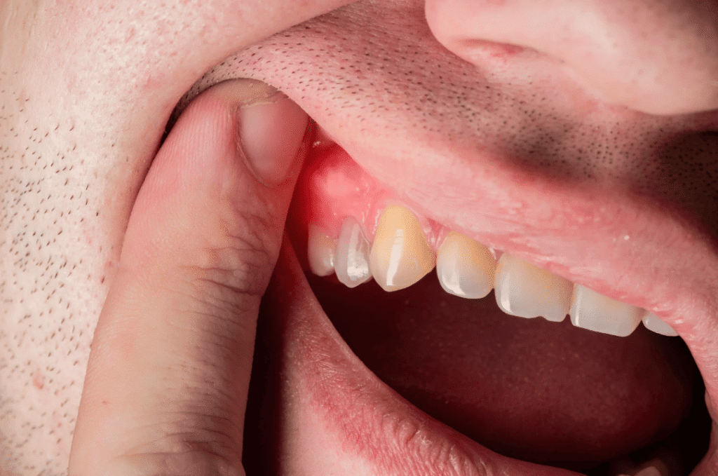 牙肉發炎成因 Causes of Gum Inflammation