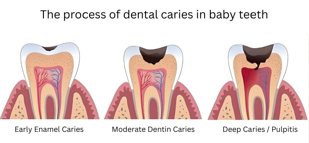 This diagram illustrates the three stages of cavities in baby teeth, from early enamel caries and moderate dentin caries to deep caries/pulpitis, showing the progression of tooth decay.