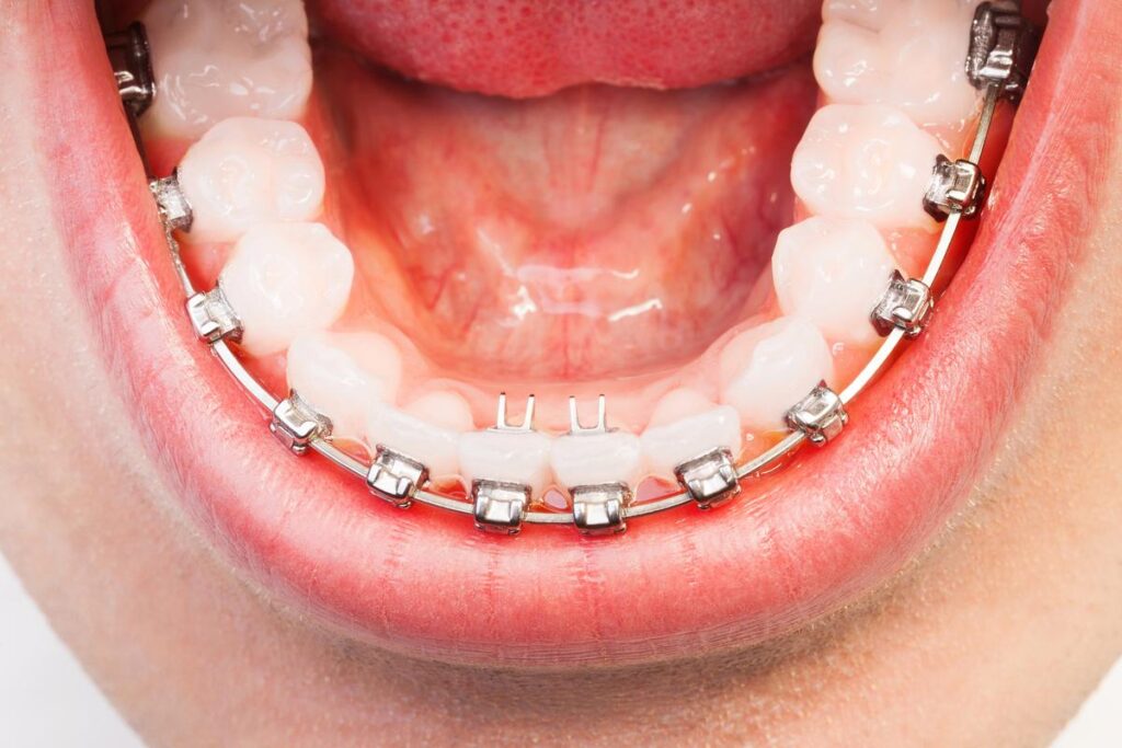 Close-up of teeth with metal braces, cover image for the blog post "Cleaning Teeth with Braces"