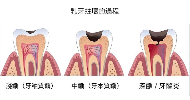 這張圖展示乳牙蛀牙的三個發展階段,從淺齲、中齲到深齲/牙髓炎,清晰呈現牙齒齲壞的過程。