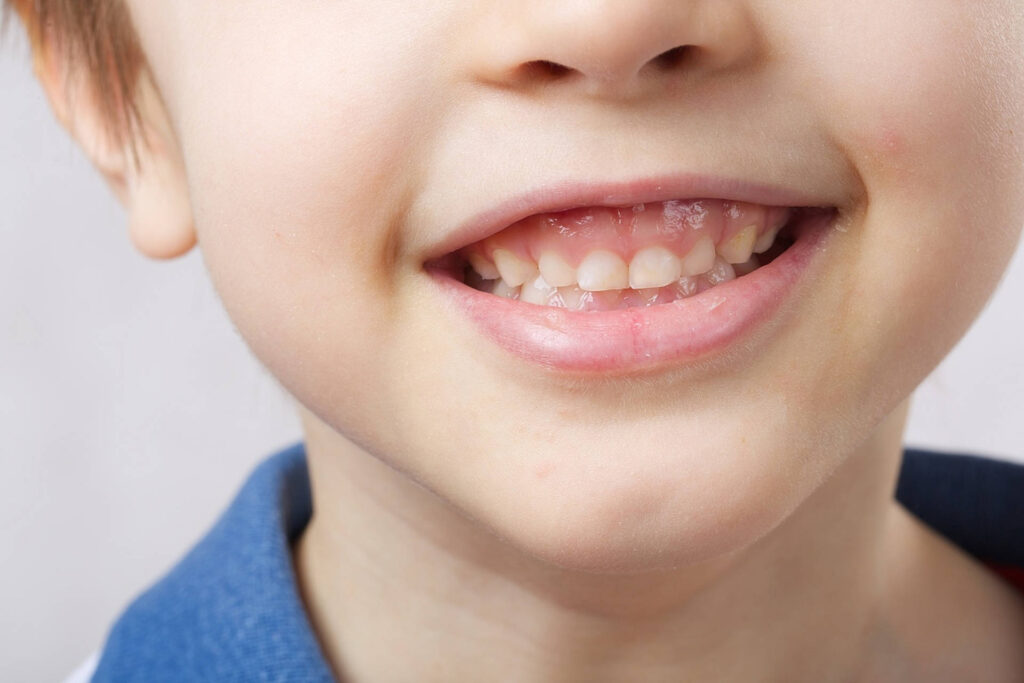 Close-up of a smiling child showing teeth – cover image for an article on cavities in baby teeth and oral health.