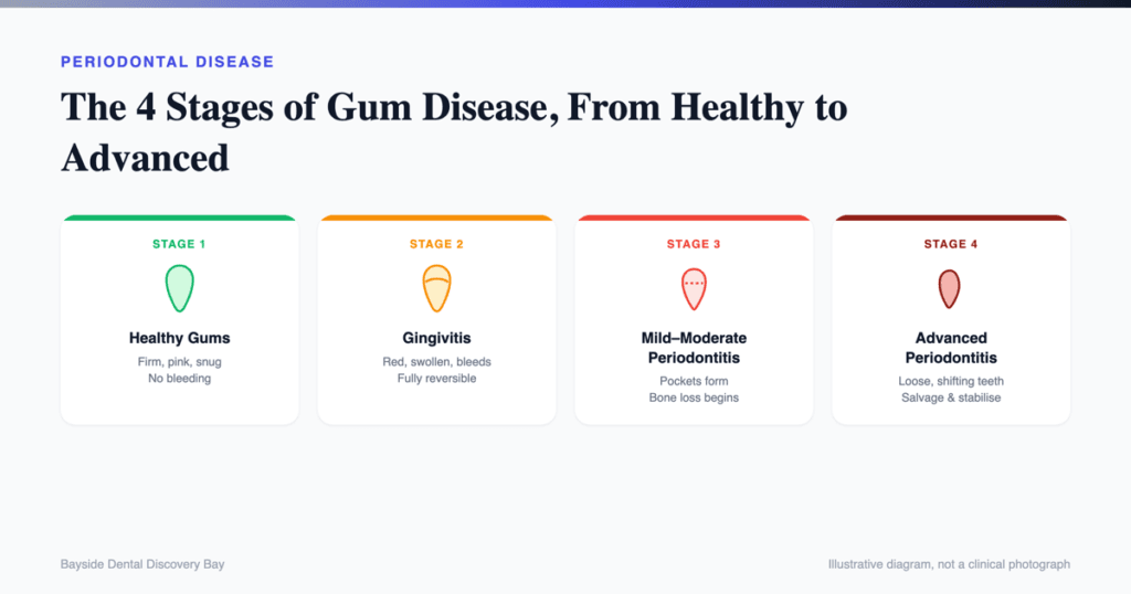 The 4 stages of gum disease from healthy gums to advanced periodontitis