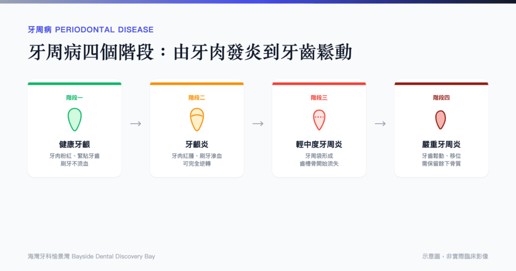 牙周病四個階段：從健康牙齦到嚴重牙周炎示意圖