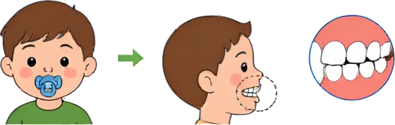 A dummy habit can affect how teeth line up