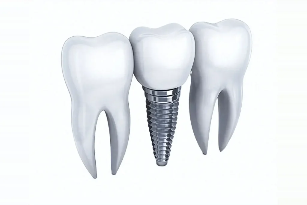 植牙示意圖：鈦金屬人工牙根連接牙冠，位於兩顆天然牙之間 Dental implant illustration: titanium implant and crown between two natural teeth