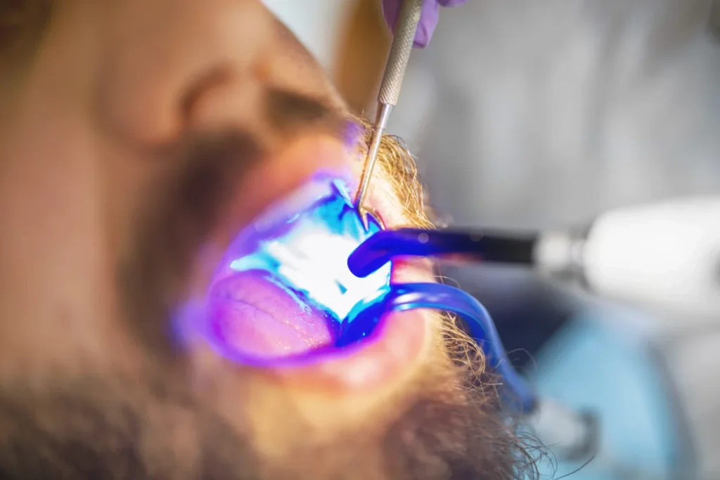 牙醫以藍光固化燈令牙色補牙物料硬化 Dentist using a blue curing light to harden a tooth-coloured filling