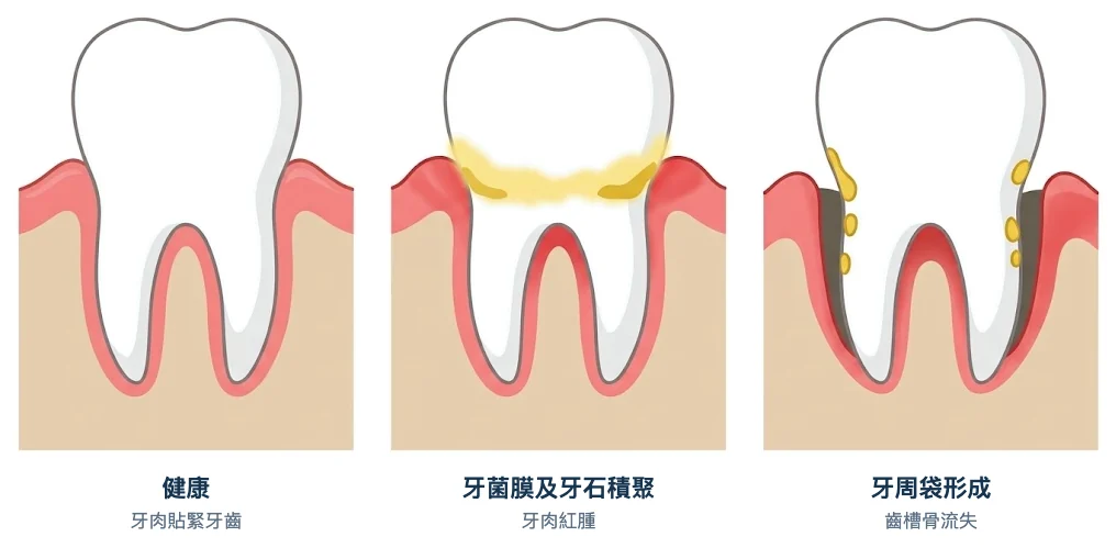 牙周袋形成示意圖：健康牙肉、牙菌膜及牙石積聚、細菌沿牙根向下形成深牙周袋並令齒槽骨流失