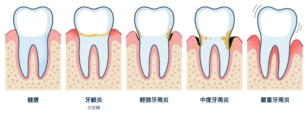 牙周病階段剖面示意圖：健康、牙齦炎、輕微、中度及嚴重牙周炎的牙肉與齒槽骨變化