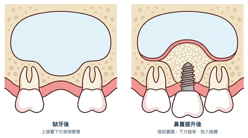 鼻竇提升術前後示意圖:缺牙後上頜竇下方骨頭變薄;手術提起竇膜、下方植骨,再放入植體