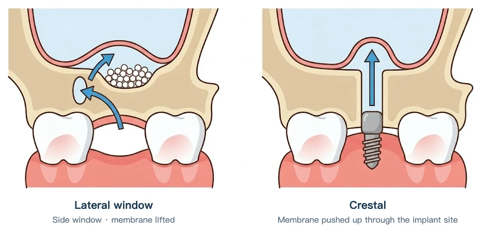 Lateral window vs crestal sinus lift: the lateral approach lifts the membrane through a side window; the crestal approach pushes it up through the implant site
