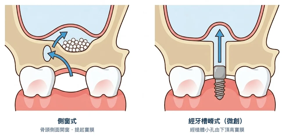 側窗式與經牙槽嵴式鼻竇提升示意圖:側窗式從骨頭側面開窗提起竇膜;經牙槽嵴式經植體小孔由下向上頂高竇膜