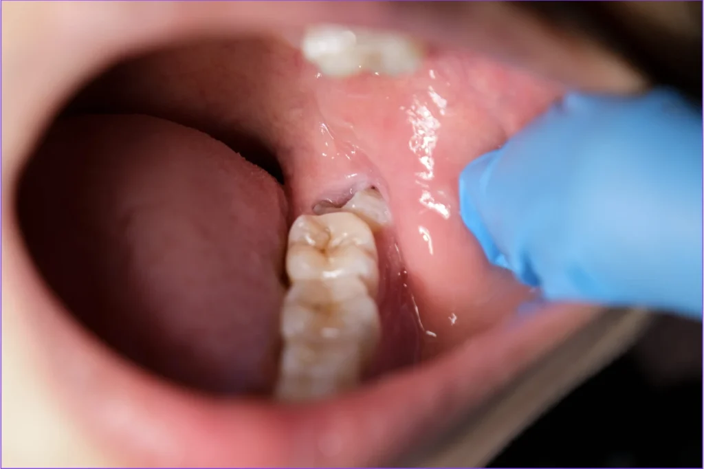 智慧齒位置及周圍牙肉 / Wisdom tooth and surrounding gum tissue